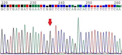 C677T Gene Polymorphism of MTHFR Is a Risk Factor for Impaired Renal Function in Pregnant Women With Preeclampsia in the Chinese Han Population